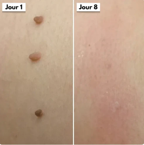Dermaclear Pro™- Éliminez vos acrochordons en 7 jours sans douleur !