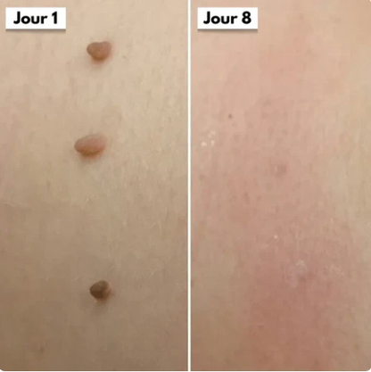Dermaclear Pro™- Éliminez vos acrochordons en 7 jours sans douleur !