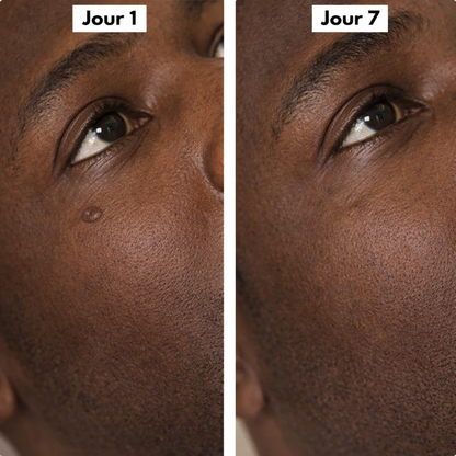 Dermaclear Pro™- Éliminez vos acrochordons en 7 jours sans douleur !