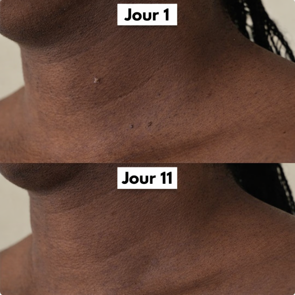 Dermaclear Pro™- Éliminez vos acrochordons en 7 jours sans douleur !