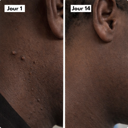 Dermaclear Pro™- Éliminez vos acrochordons en 7 jours sans douleur !