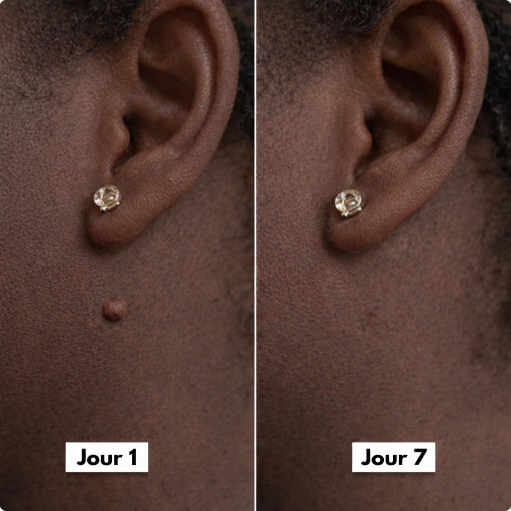 Dermaclear Pro™- Éliminez vos acrochordons en 7 jours sans douleur !
